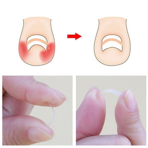 Ingrown Toenail Treatment Remedy