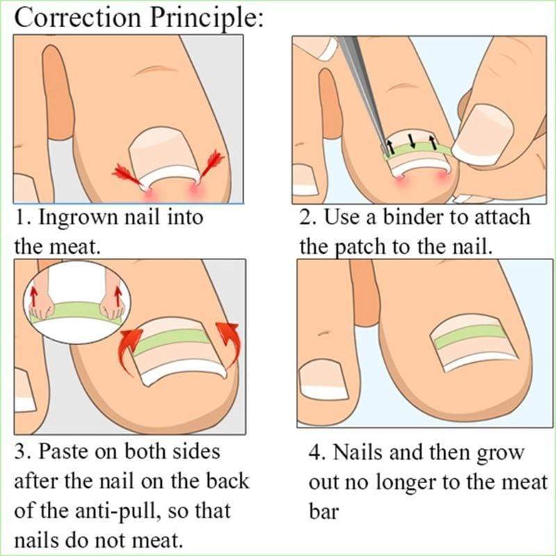 Ingrown Toenail Treatment Remedy