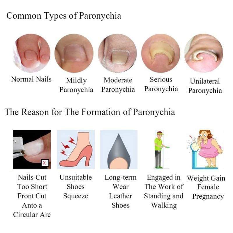 Ingrown Toenail Treatment Remedy