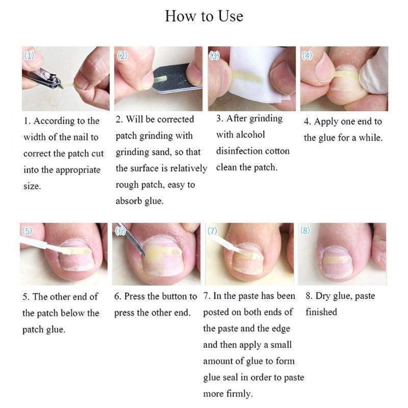 Ingrown Toenail Treatment Remedy